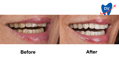 Before & After: Dental Veneers in Spain