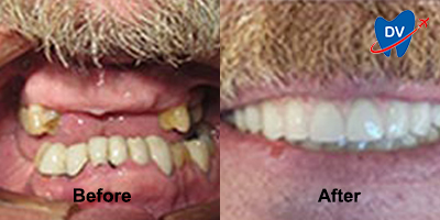 Before & After Image of Full Mouth Rehab