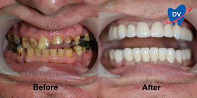 Before & After Image of Dental Crowns