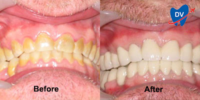 Before & After Smile Makeover in Philippines