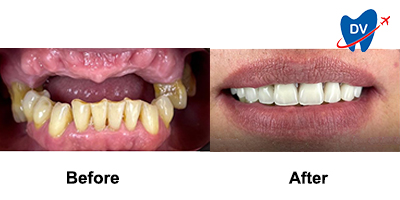 All-on-4 Dental Implants in Poland Before & After