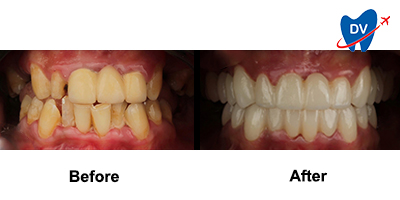 Before & After: Smile Makeover in Egypt