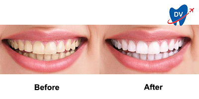 Before & After: Teeth Whitening in El Salvador