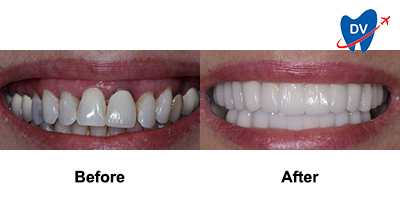 Before & After: Dental Bridges in Dubai
