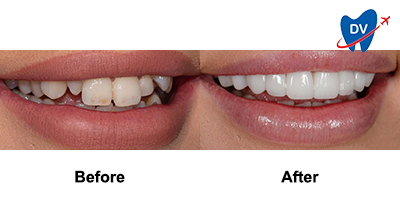Before & After: Dental Veneers in Dubai