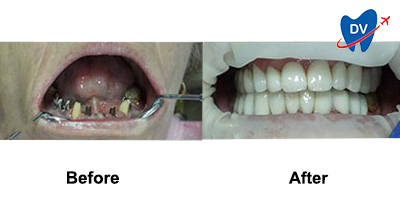 Before & After: Full Mouth Rehab