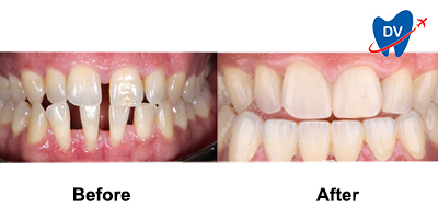 Before & After Image of Smile Makeover