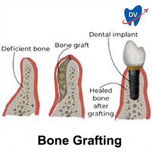 Bone graft