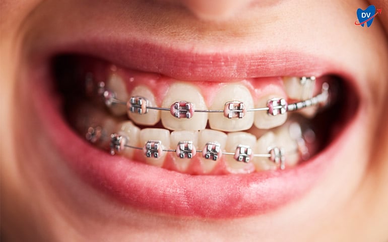 Dental braces