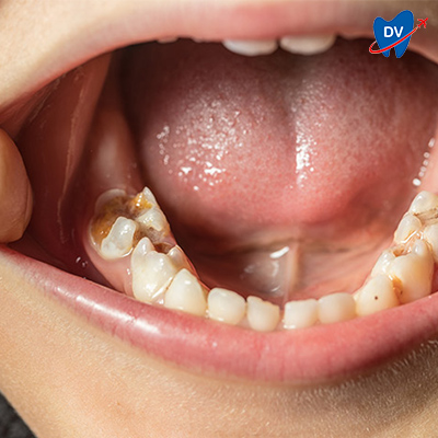 Dental Caries in Children