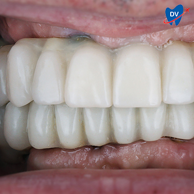 Same-day dental implants in Croatia