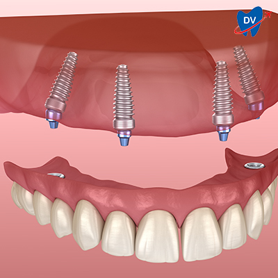 All on 4 dental implants in Bangalore, India