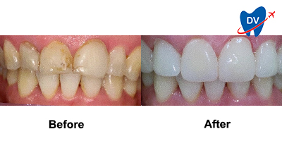 Before & After: Cerec Crowns in Tijuana