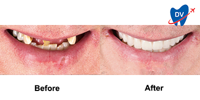 Before & After: Dental Implants in Nuevo Progreso