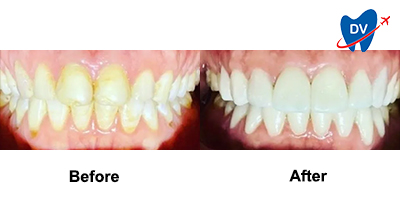 Porcelain veneers in Mexico | Before & After