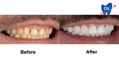 Before & After: Dental Veneers in Nogales from the Best Dentist in Nogales, Mexico