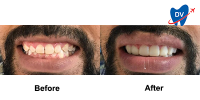 Before & After: Dental Veneers in Nuevo Laredo