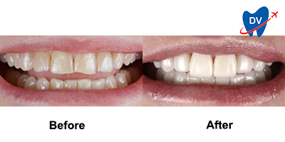 Before & After: Dental Veneers in Nuevo Progreso