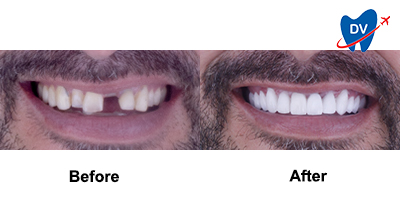 Before & After: Dental Work in Playa del Carmen