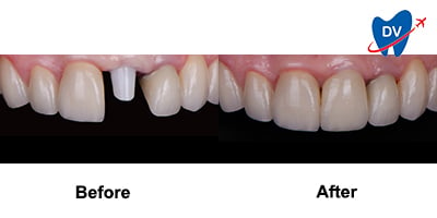 Before & After: Dental implants in Playa de Coco