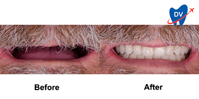 Before & After: Dentures in Playa de Coco