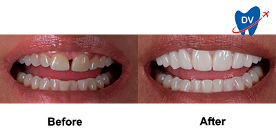 Emax Veneers in Mexico | Before & After