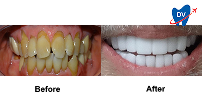 Full Mouth Restoration in Mexico - Before & After