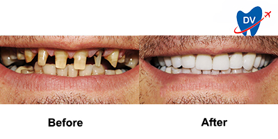 Before & After: Full Mouth Rehab in Merida