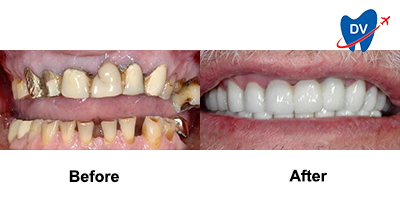 Before & After: Full Mouth Rehab in San Jose del Cabo