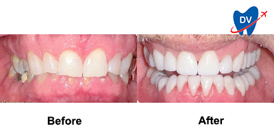 Before & After: Full Mouth Rehab in Tijuana