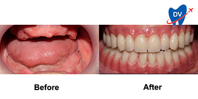 Before & After: Implant Dentures in Mexicali