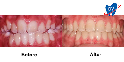 Before & After: Braces in Jaco