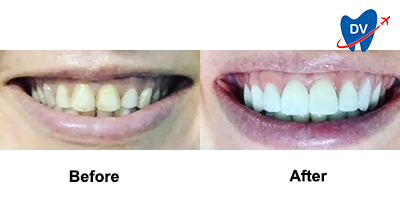 Before & After: Smile Makeover in Mexico City