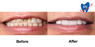 Before & After: Smile Makeover from the Best Dentist in Nogales, Mexico