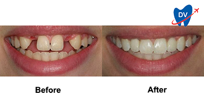 Before & After: Dental Implants in Jaco