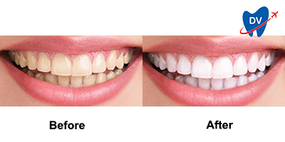 Before & After: Teeth Whitening in Merida