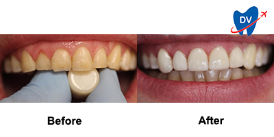 Before & After: Dental Veneers in Mexicali