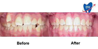 Before & After: Braces in Monterrey
