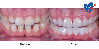 Before & After: Dental Crowns in Matamoros