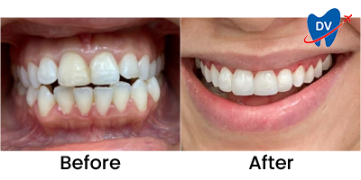 Before & After: Dental Veneers in Cartagena