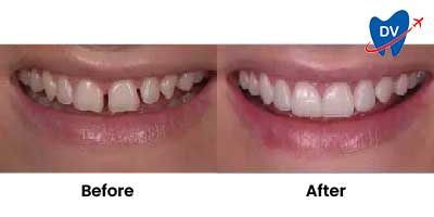 Before & After: Dental Veneers in Chapala