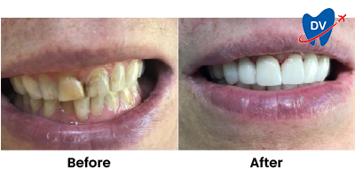Before & After: Cosmetic Dental Treatment in Chapala