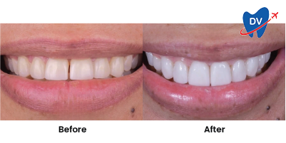 Before & After: Dental Veneers in Matamoros