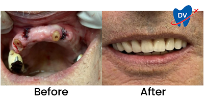 Before & After: Full Mouth Rehab in Cartagena