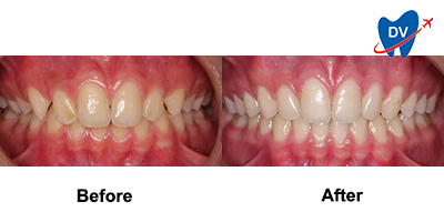 Before & After: Teeth Whitening in Monterrey