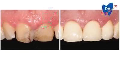Before & After: Dental Crowns in Zadar