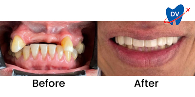 Before & After: Dental Implants in Bogota