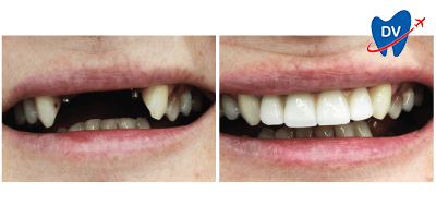 Before & After: Dental Implants in Zadar