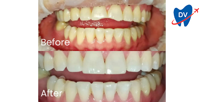 Before & After: Dental Veneers in Barranquilla