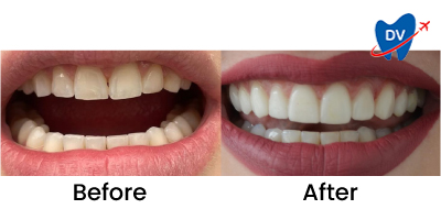 Before & After: Dental Veneers in Bogota
